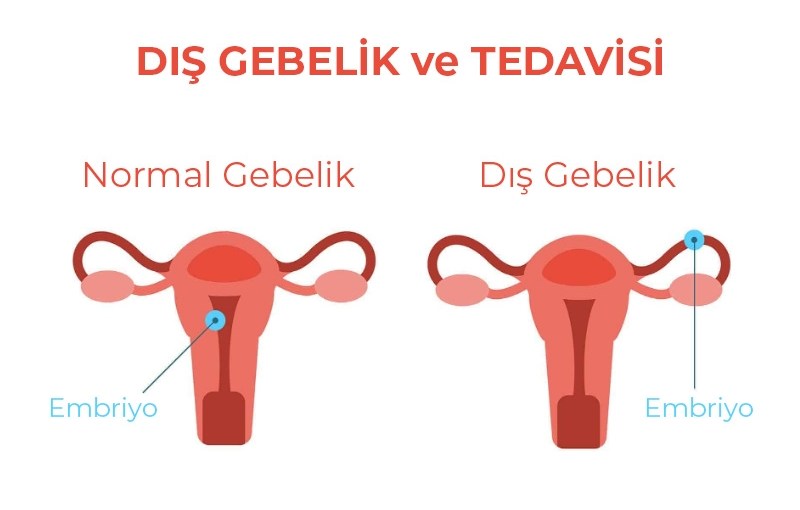 Dış Gebelik Tedavisi Hakkında Bilmeniz&nbsp;Gerekenler